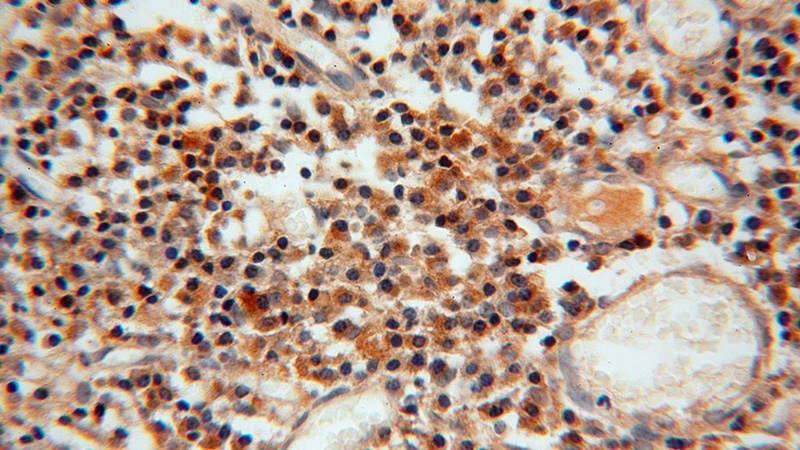 Immunohistochemical of paraffin-embedded human cervix using Catalog No:114239(PRPSAP1 antibody) at dilution of 1:100 (under 40x lens)