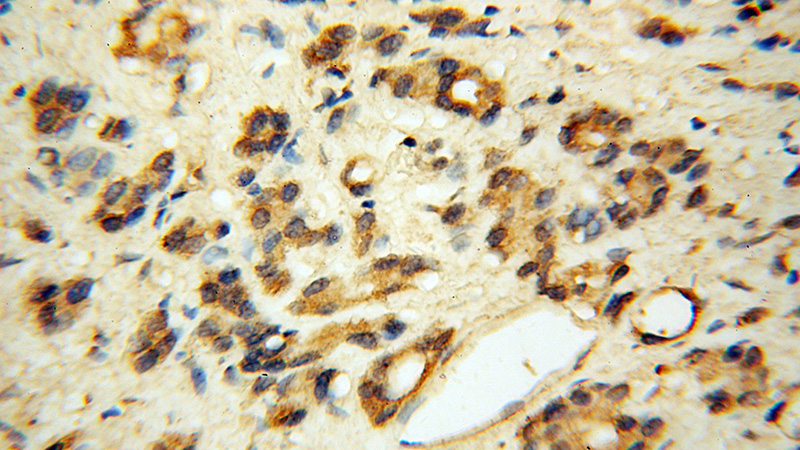 Immunohistochemical of paraffin-embedded human gliomas using Catalog No:112164 (LC3 antibody) at dilution of 1:50 (under 40x lens).