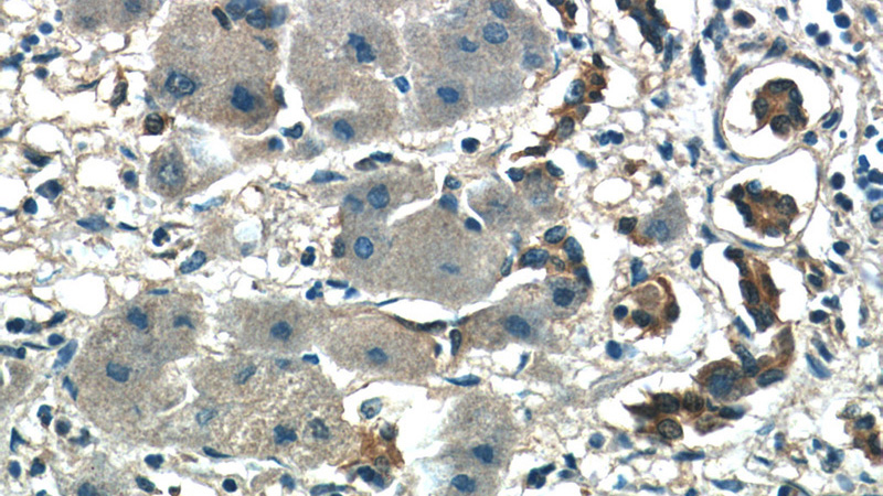 Immunohistochemistry of paraffin-embedded human hepatocirrhosis tissue slide using Catalog No:108830(CALM2 Antibody) at dilution of 1:50 (under 40x lens)