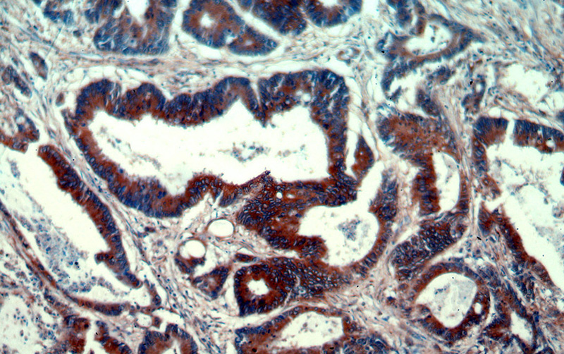 Immunohistochemical of paraffin-embedded human colon cancer using Catalog No:114353(PYCR1 antibody) at dilution of 1:50 (under 10x lens)