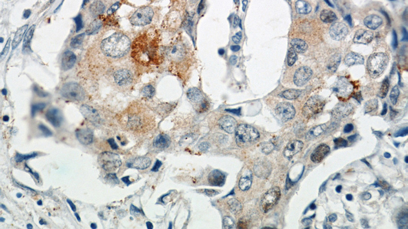Immunohistochemical of paraffin-embedded human breast cancer using Catalog No:112380(MAGEA4 antibody) at dilution of 1:50 (under 40x lens)