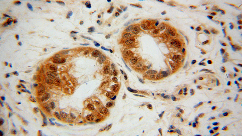 Immunohistochemical of paraffin-embedded human pancreas cancer using Catalog No:113847(PRKCB antibody) at dilution of 1:50 (under 40x lens)