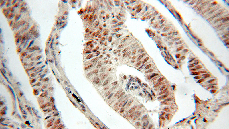 Immunohistochemical of paraffin-embedded human pancreas cancer using Catalog No:115816(SUB1 antibody) at dilution of 1:50 (under 25x lens)