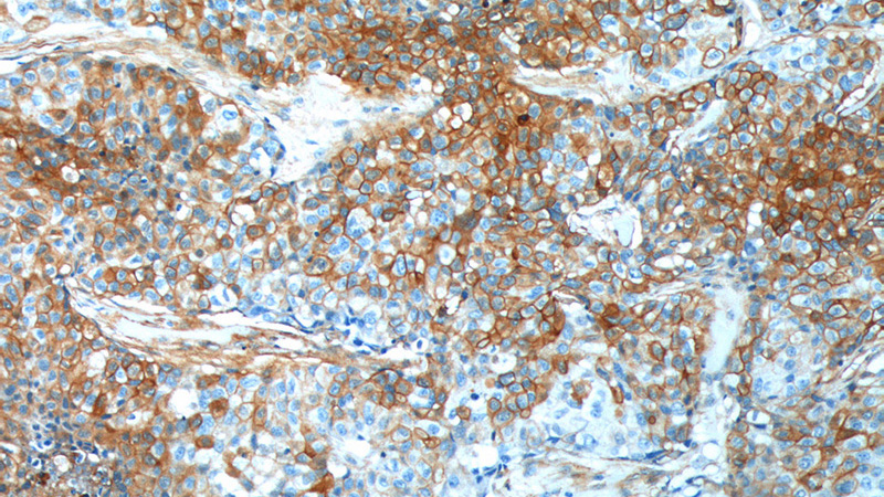 Immunohistochemistry of paraffin-embedded human lung cancer tissue slide using Catalog No:114954(S100A10 Antibody) at dilution of 1:400 (under 10x lens).