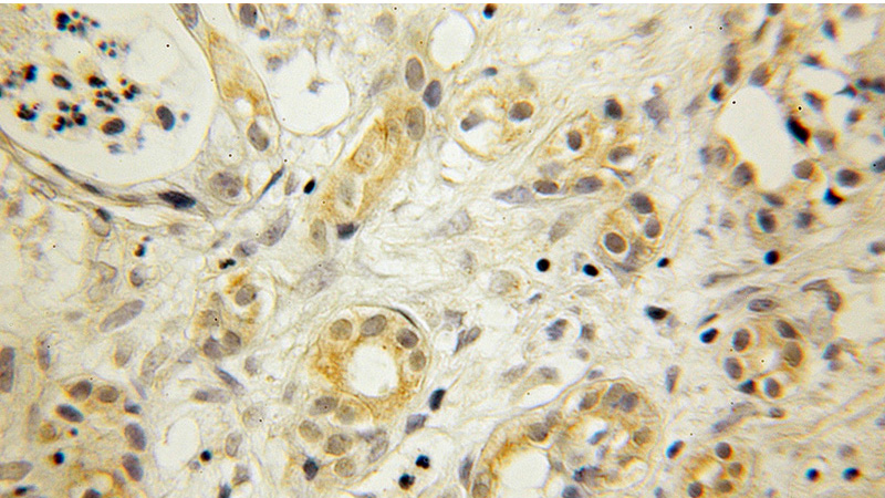 Immunohistochemical of paraffin-embedded human pancreas cancer using Catalog No:109784(CYB5A antibody) at dilution of 1:50 (under 10x lens)