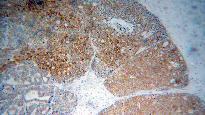 Immunohistochemical of paraffin-embedded human liver cancer using Catalog No:113993(POFUT1 antibody) at dilution of 1:50 (under 10x lens)