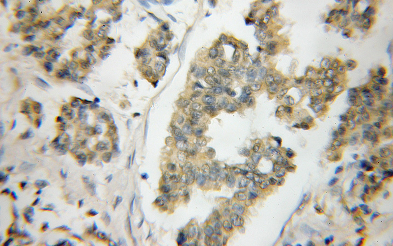 Immunohistochemical of paraffin-embedded human breast cancer using Catalog No:113325(ODF2 antibody) at dilution of 1:50 (under 10x lens)