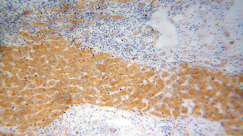 Immunohistochemical of paraffin-embedded human liver cancer using Catalog No:115819(SUCLG1 antibody) at dilution of 1:100 (under 10x lens)