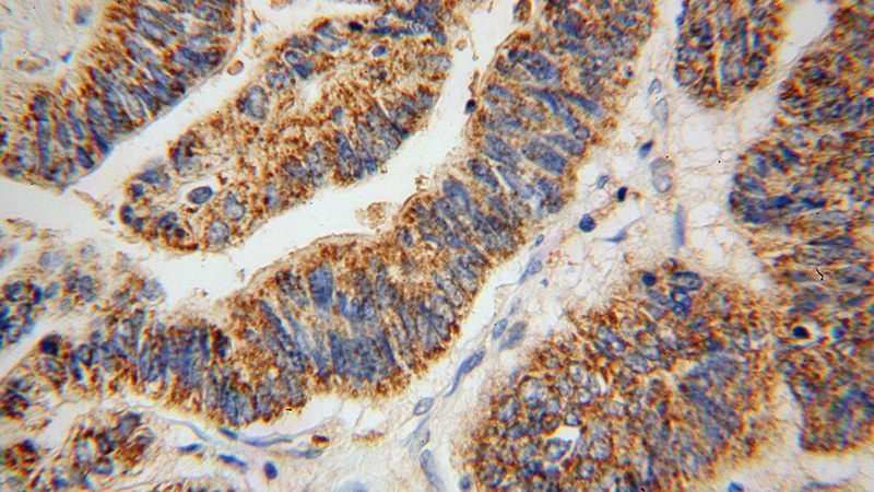 Immunohistochemical of paraffin-embedded human liver cancer using Catalog No:107808(ABCG4 antibody) at dilution of 1:50 (under 40x lens)