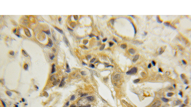 Immunohistochemical of paraffin-embedded human pancreas cancer using Catalog No:112862(MRRF antibody) at dilution of 1:50 (under 10x lens)