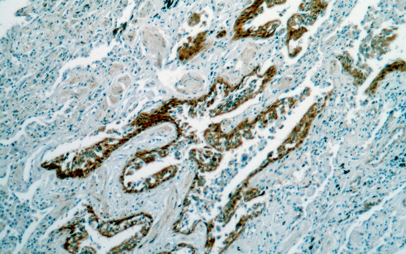 Immunohistochemical of paraffin-embedded human lung cancer using Catalog No:111699(HSPA6 antibody) at dilution of 1:50 (under 10x lens)