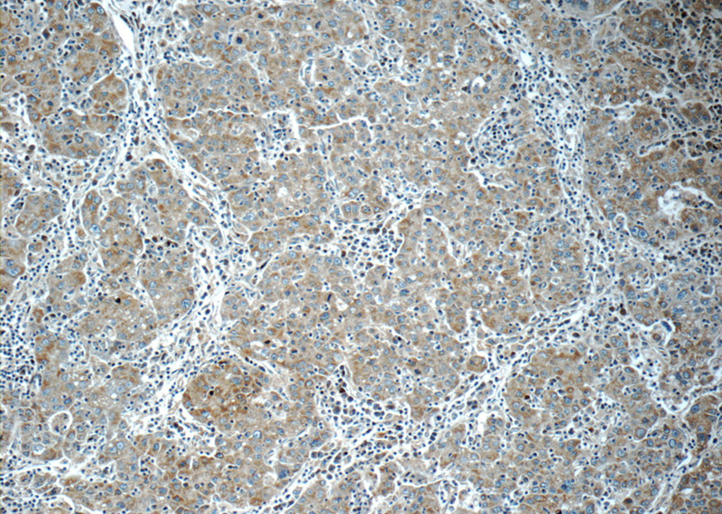 Immunohistochemistry of paraffin-embedded human liver cancer tissue slide using Catalog No:112037(C6orf221 Antibody) at dilution of 1:50 (under 10x lens)