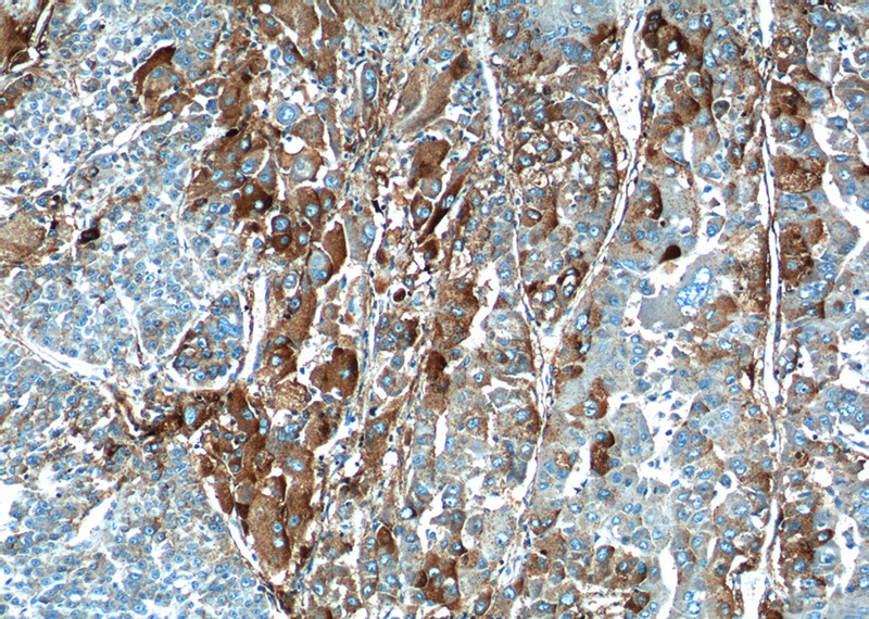 Immunohistochemistry of paraffin-embedded human liver cancer tissue slide using Catalog No:111329(HABP2 Antibody) at dilution of 1:100 (under 10x lens).