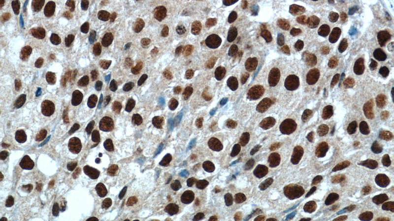 Immunohistochemistry of paraffin-embedded human breast cancer tissue slide using Catalog No:117326(Histone-H3 Antibody) at dilution of 1:50 (under 40x lens)