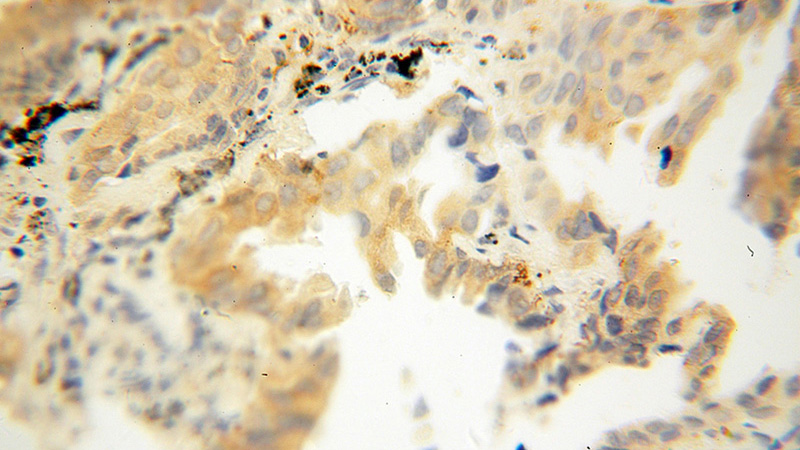 Immunohistochemical of paraffin-embedded human lung cancer using Catalog No:114583(RDH10 antibody) at dilution of 1:100 (under 40x lens)
