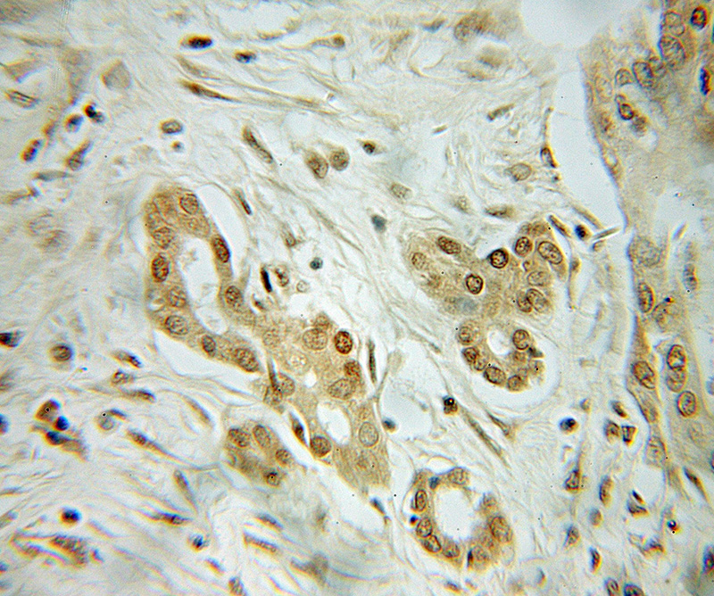Immunohistochemical of paraffin-embedded human pancreas cancer using Catalog No:116232(TRAF4 antibody) at dilution of 1:50 (under 10x lens)