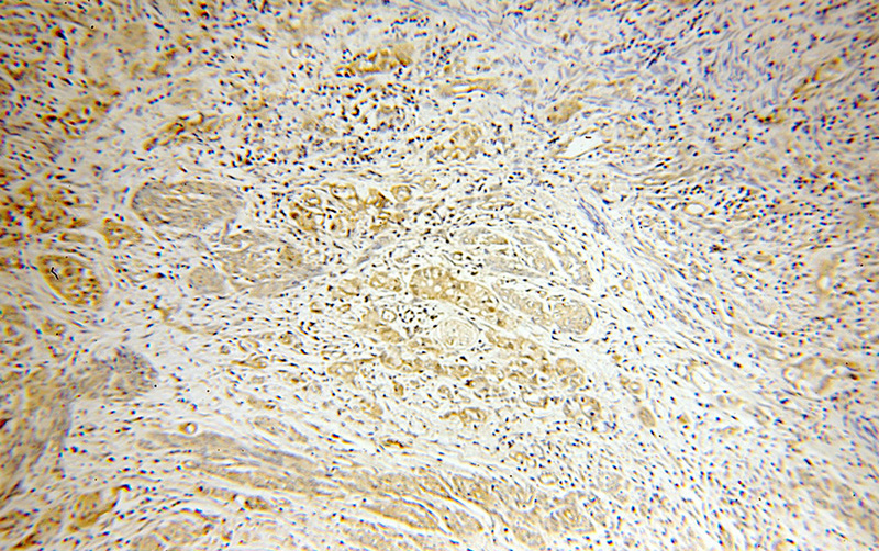 Immunohistochemical of paraffin-embedded human endometrial cancer using Catalog No:109165(CDK6 antibody) at dilution of 1:50 (under 10x lens)