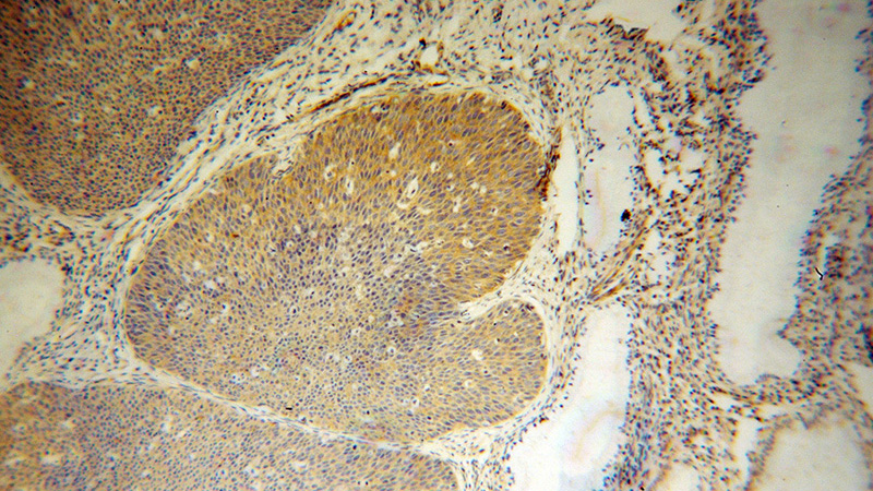 Immunohistochemical of paraffin-embedded human cervical cancer using Catalog No:107928(AKAP10 antibody) at dilution of 1:100 (under 10x lens)