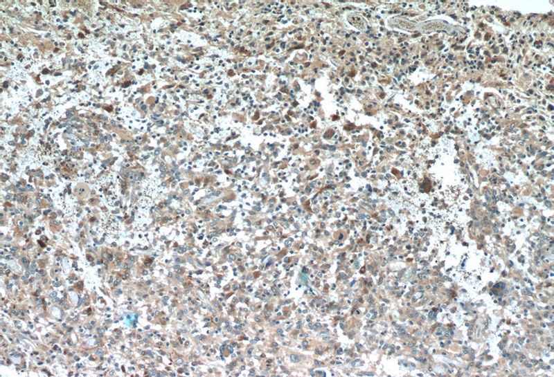 Immunohistochemistry of paraffin-embedded human gliomas tissue slide using Catalog No:115544(SPARCL1 Antibody) at dilution of 1:50 (under 10x lens)
