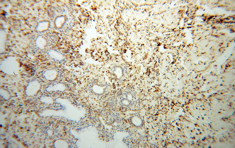 Immunohistochemical of paraffin-embedded human cervical cancer using Catalog No:110362(ERK1/2 antibody) at dilution of 1:100 (under 10x lens)