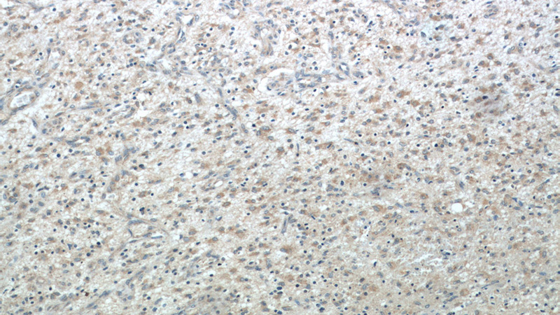 Immunohistochemical of paraffin-embedded human gliomas using Catalog No:109676(CYFIP2 antibody) at dilution of 1:50 (under 10x lens)