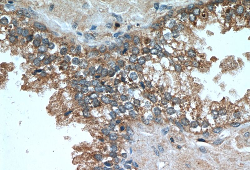 Immunohistochemistry of paraffin-embedded human prostate cancer tissue slide using Catalog No:107076 (B2M Antibody) at dilution of 1:200 (under 40x lens)
