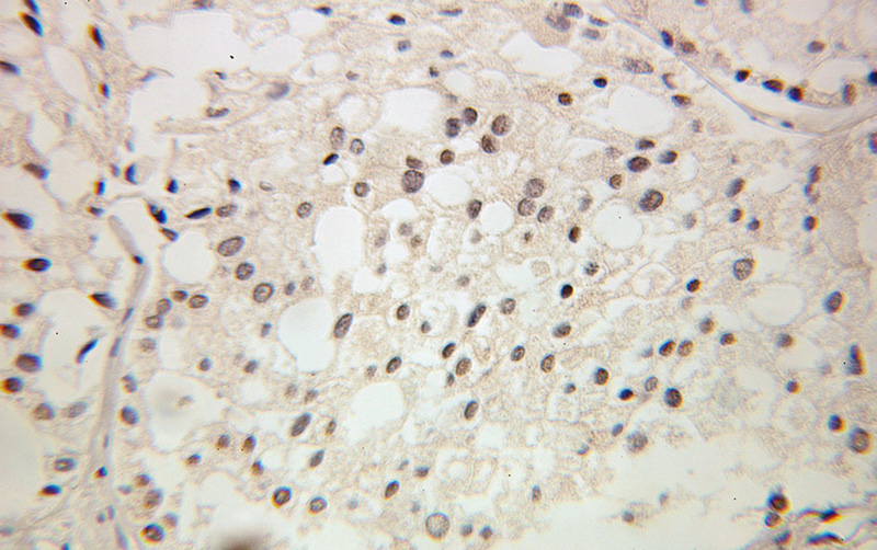 Immunohistochemical of paraffin-embedded human prostate cancer using Catalog No:111228(GTF2A2 antibody) at dilution of 1:100 (under 25x lens)