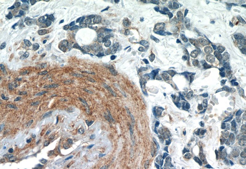 Immunohistochemistry of paraffin-embedded human cervical cancer tissue slide using Catalog No:115864(TBC1D22A Antibody) at dilution of 1:50 (under 40x lens)