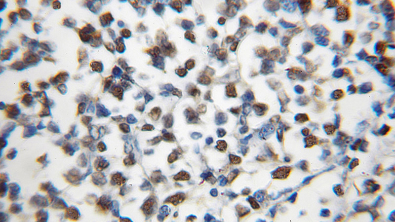 Immunohistochemical of paraffin-embedded human lymphoma using Catalog No:112555(MCM5 antibody) at dilution of 1:100 (under 10x lens)