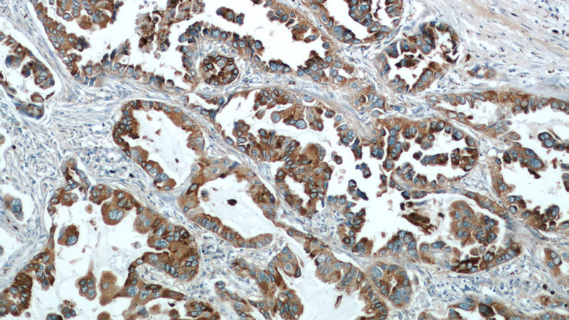 Immunohistochemical of paraffin-embedded human lung cancer using Catalog No:107321(NAPSA antibody) at dilution of 1:50 (under 10x lens)