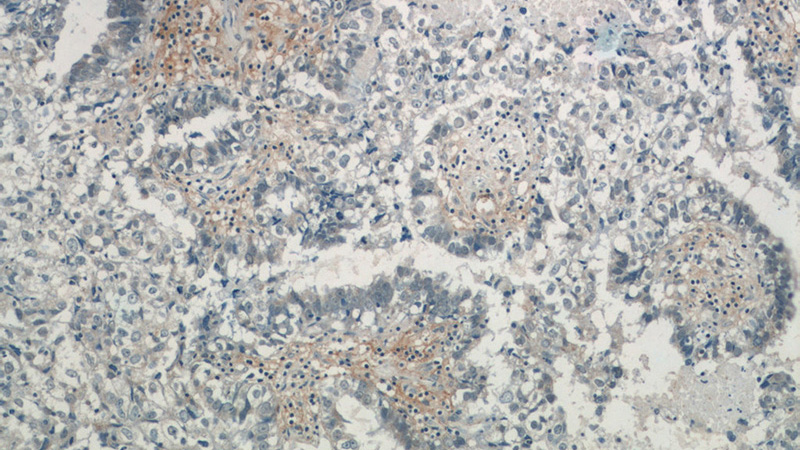 Immunohistochemistry of paraffin-embedded human breast cancer tissue slide using Catalog No:114241(PRR13 Antibody) at dilution of 1:50 (under 10x lens)