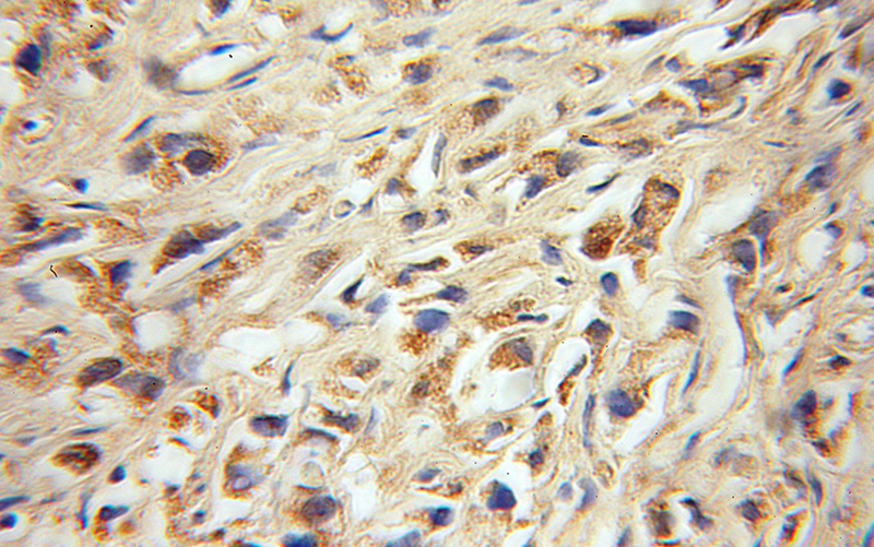 Immunohistochemical of paraffin-embedded human gliomas using Catalog No:112005(KIF1C antibody) at dilution of 1:100 (under 10x lens)