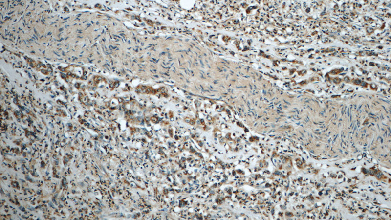 Immunohistochemistry of paraffin-embedded human stomach cancer tissue slide using Catalog No:116139(TIMP1 Antibody) at dilution of 1:50 (under 10x lens)