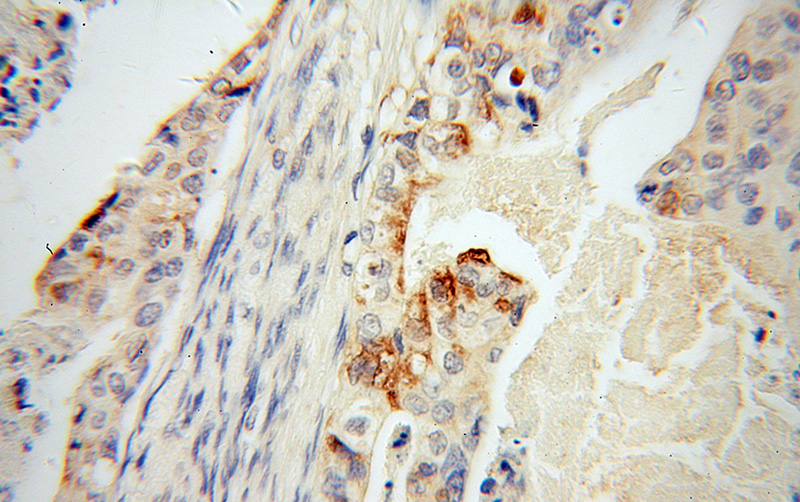 Immunohistochemical of paraffin-embedded human stomach cancer using Catalog No:116354(TFF1 antibody) at dilution of 1:50 (under 40x lens)