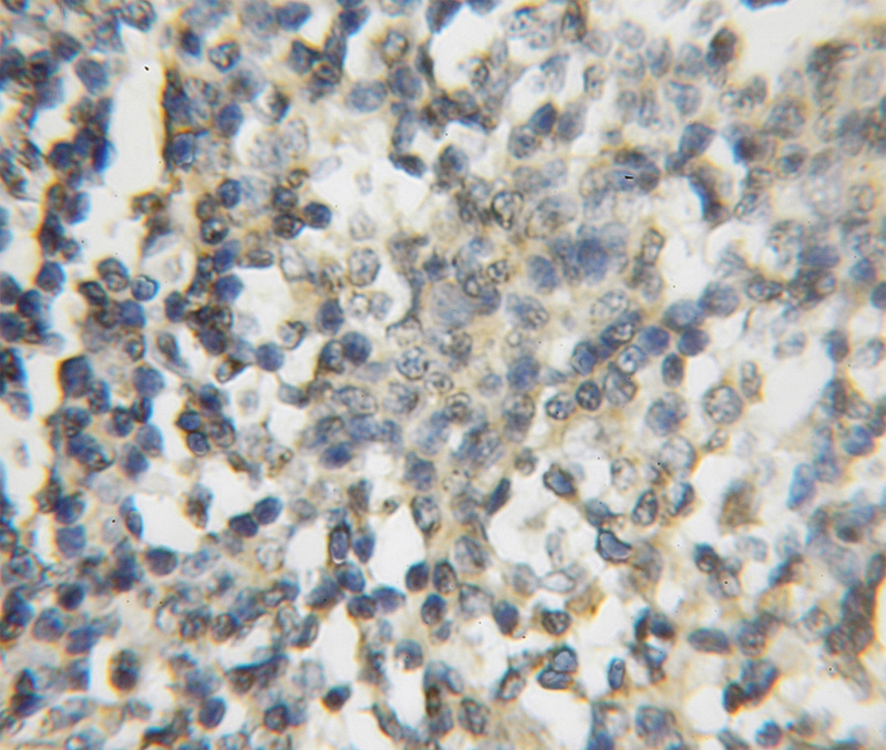 Immunohistochemical of paraffin-embedded human lymphoma using Catalog No:110741(FNTB antibody) at dilution of 1:50 (under 10x lens)