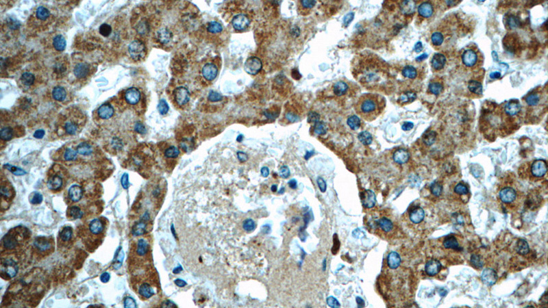 Immunohistochemistry of paraffin-embedded human liver tissue slide using Catalog No:107792(ADHFE1 Antibody) at dilution of 1:50(under 40x lens)