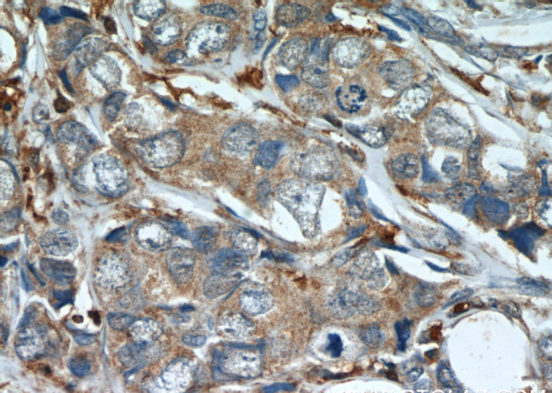 Immunohistochemistry of paraffin-embedded human breast cancer slide using Catalog No:112463(SCGB2A2 Antibody) at dilution of 1:50