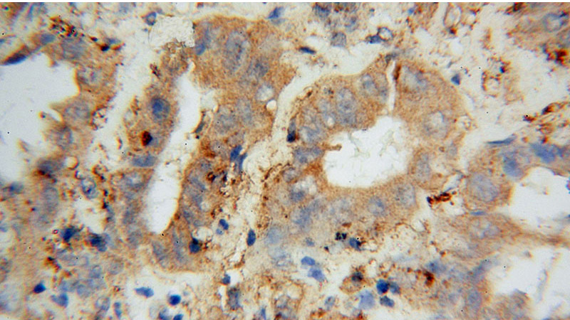Immunohistochemical of paraffin-embedded human lung cancer using Catalog No:114171(PRCP antibody) at dilution of 1:50 (under 40x lens)