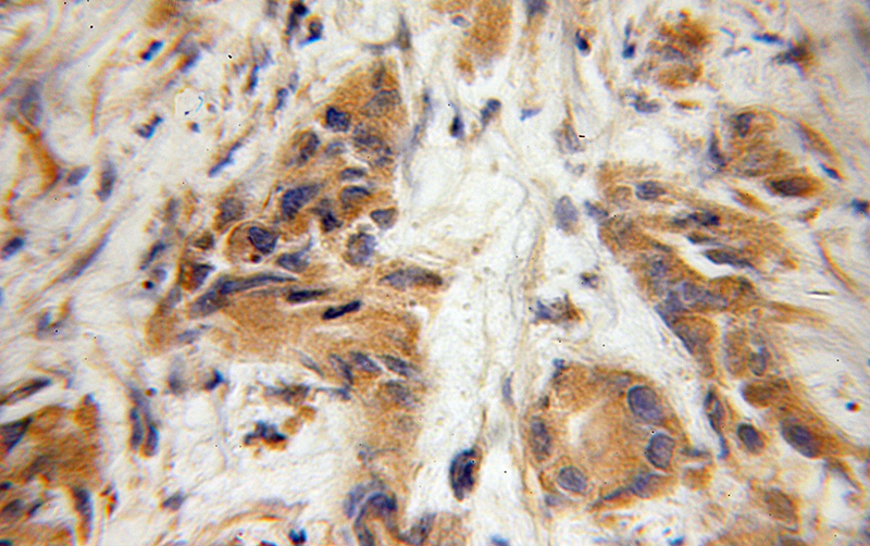 Immunohistochemical of paraffin-embedded human prostate cancer using Catalog No:111670(IFT57 antibody) at dilution of 1:50 (under 10x lens)