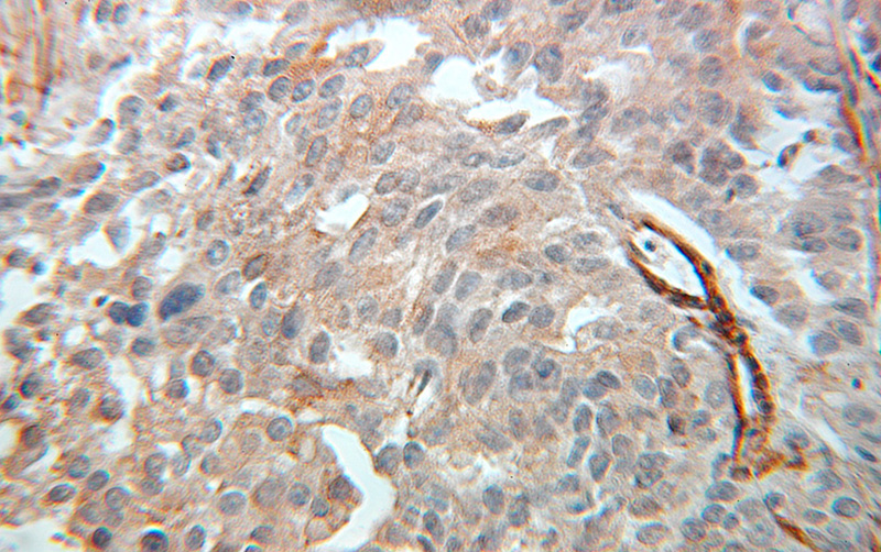 Immunohistochemical of paraffin-embedded human prostate cancer using Catalog No:109574(DPYSL5 antibody) at dilution of 1:100 (under 25x lens)