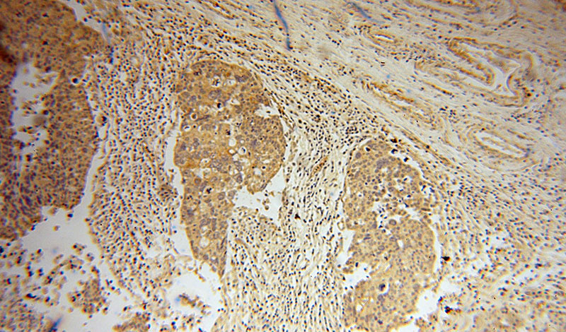 Immunohistochemical of paraffin-embedded human ovary tumor using Catalog No:111083(GLYATL1 antibody) at dilution of 1:100 (under 10x lens)