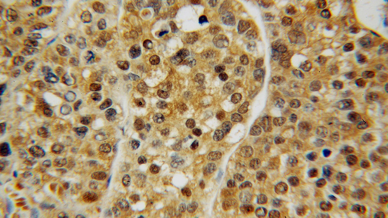 Immunohistochemical of paraffin-embedded human liver cancer using Catalog No:114377(PSMA7 antibody) at dilution of 1:50 (under 40x lens)