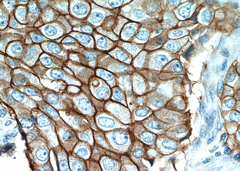 Immunohistochemical of paraffin-embedded human breast cancer using Catalog No:111295(ERBB2,p185-Specific antibody) at dilution of 1:50 (under 40x lens)