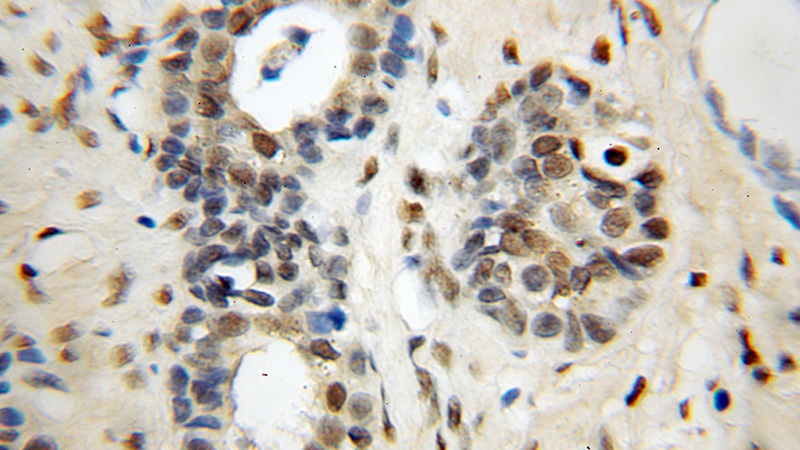 Immunohistochemical of paraffin-embedded human prostate cancer using Catalog No:113150(NFIA antibody) at dilution of 1:25 (under 10x lens)