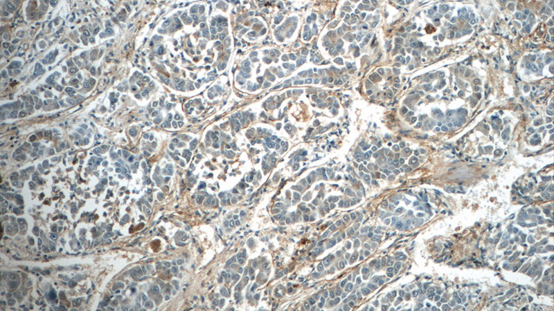 Immunohistochemistry of paraffin-embedded human liver cancer tissue slide using Catalog No:116109(TMEM181 Antibody) at dilution of 1:50 (under 10x lens)
