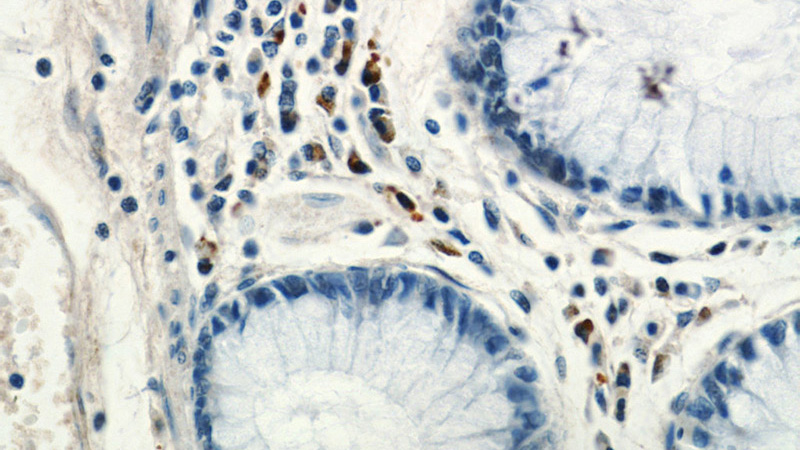 Immunohistochemistry of paraffin-embedded human colon tissue slide using Catalog No:108999(CCL17 Antibody) at dilution of 1:50 (under 40x lens)