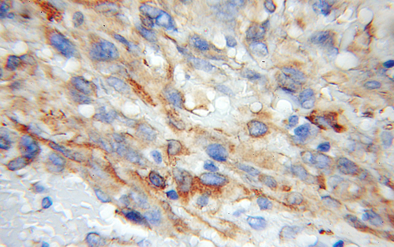 Immunohistochemical of paraffin-embedded human gliomas using Catalog No:114579(RCN2 antibody) at dilution of 1:50 (under 10x lens)