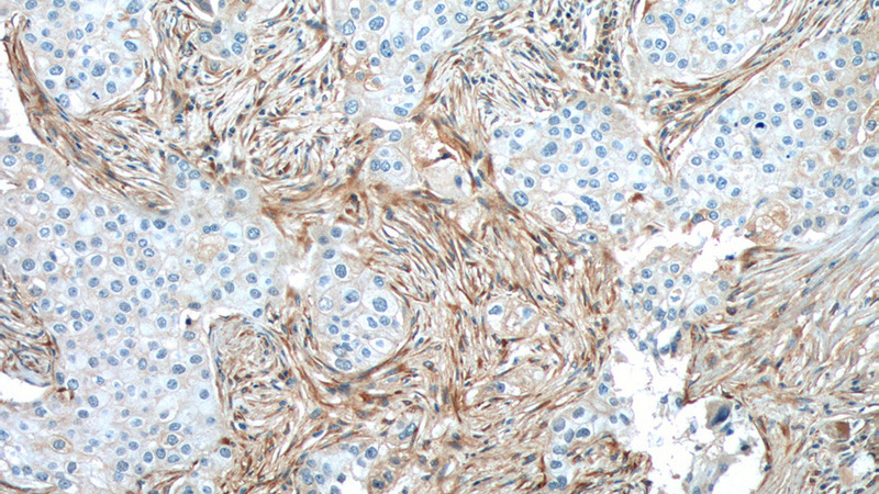 Immunohistochemistry of paraffin-embedded human breast cancer tissue slide using Catalog No:109375(COL1A2 Antibody) at dilution of 1:200 (under 10x lens). heat mediated antigen retrieved with Tris-EDTA buffer(pH9).
