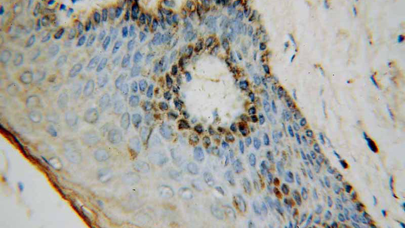 Immunohistochemical of paraffin-embedded human skin cancer using Catalog No:113389(NSUN5 antibody) at dilution of 1:50 (under 40x lens)