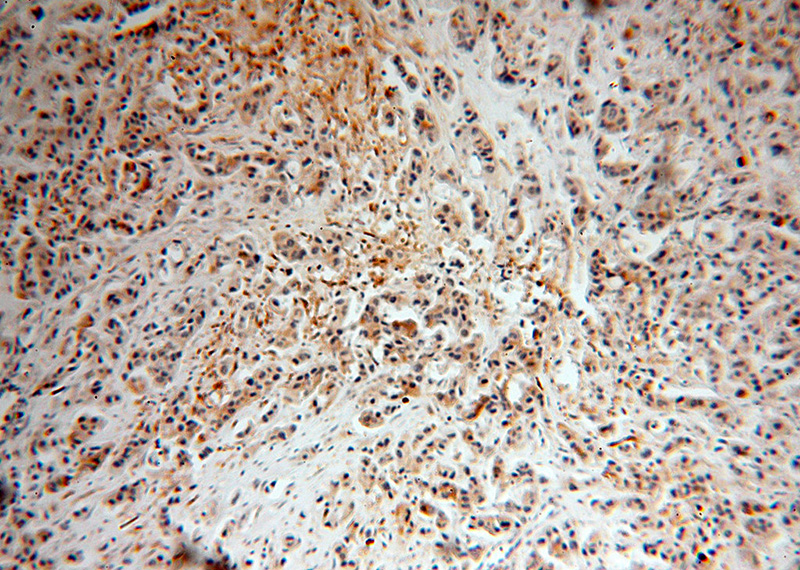 Immunohistochemical of paraffin-embedded human breast cancer using Catalog No:115597(SRPR antibody) at dilution of 1:50 (under 10x lens)